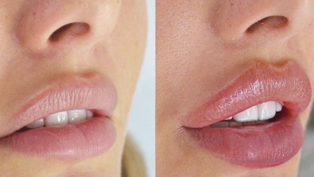  lip-filler-before-after.